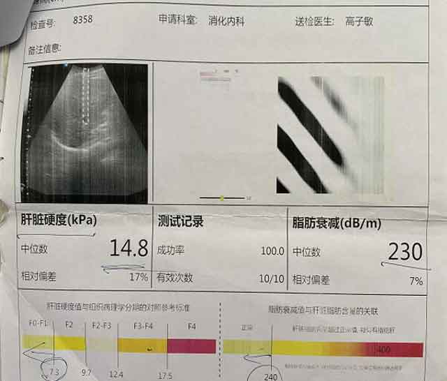 郑州肝硬化医院哪家好?河南治肝硬化那个医院好