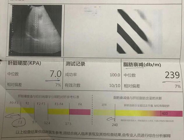 郑州肝硬化医院好的是哪个